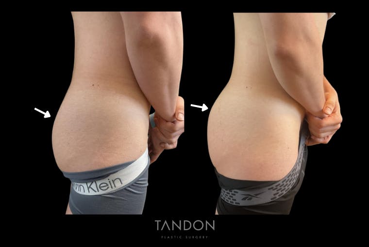 AlloClae Before & After Gallery - Patient 345714 - Image 2