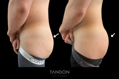 AlloClae Before & After Gallery - Patient 345714 - Image 1