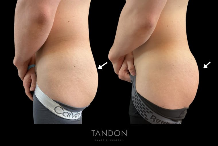 AlloClae Before & After Gallery - Patient 345714 - Image 1