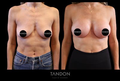 Breast Augmentation Before & After Gallery - Patient 710988 - Image 1