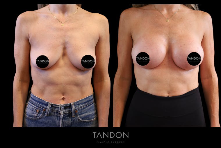 Breast Augmentation Before & After Gallery - Patient 710988 - Image 1