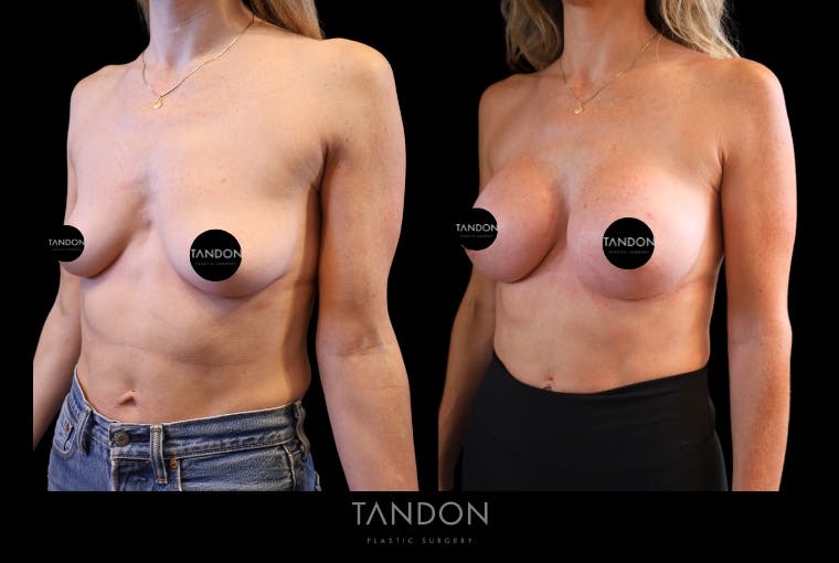 Breast Augmentation Before & After Gallery - Patient 710988 - Image 2