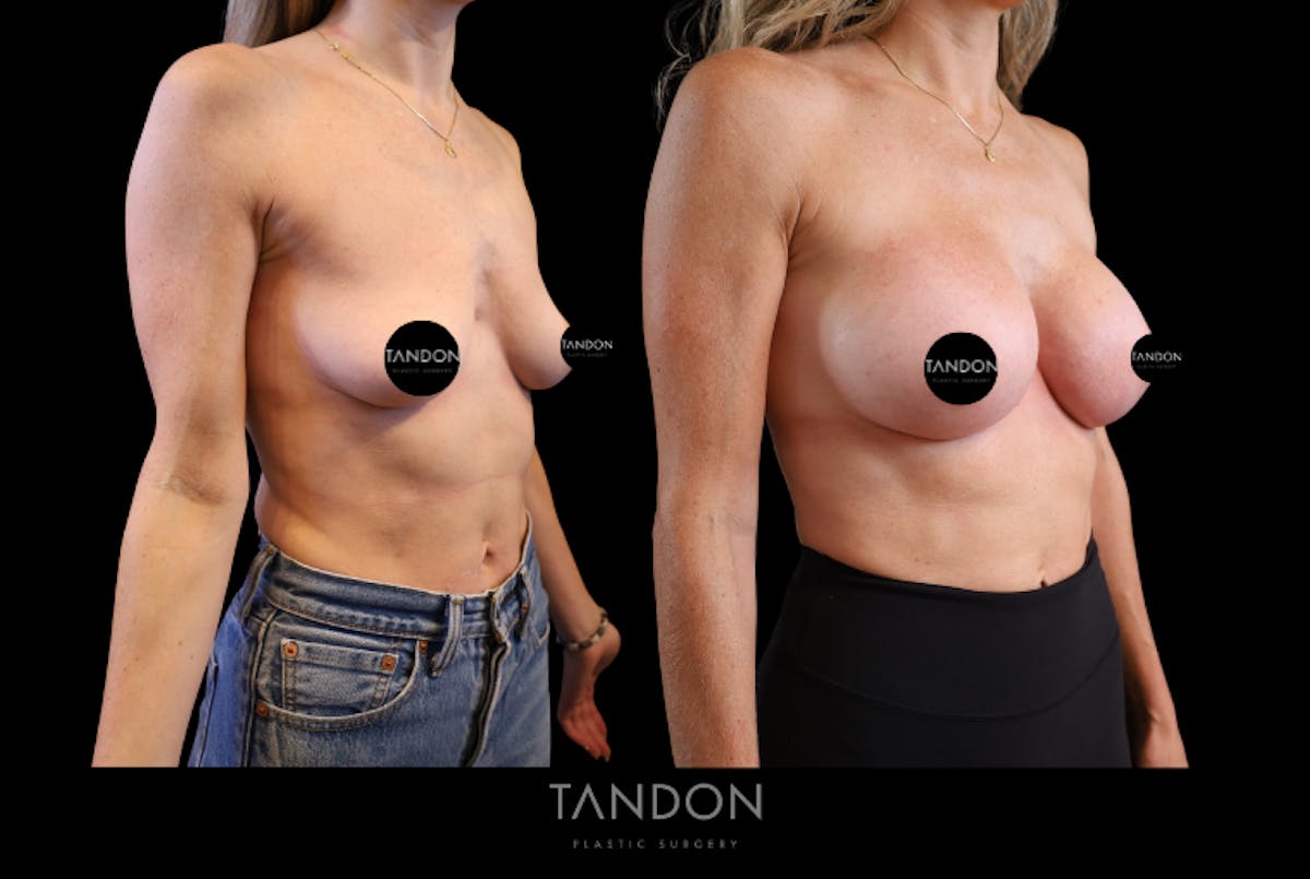 Breast Augmentation  Before & After Gallery - Patient 710988 - Image 4