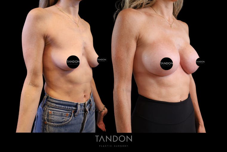 Breast Augmentation Before & After Gallery - Patient 710988 - Image 4