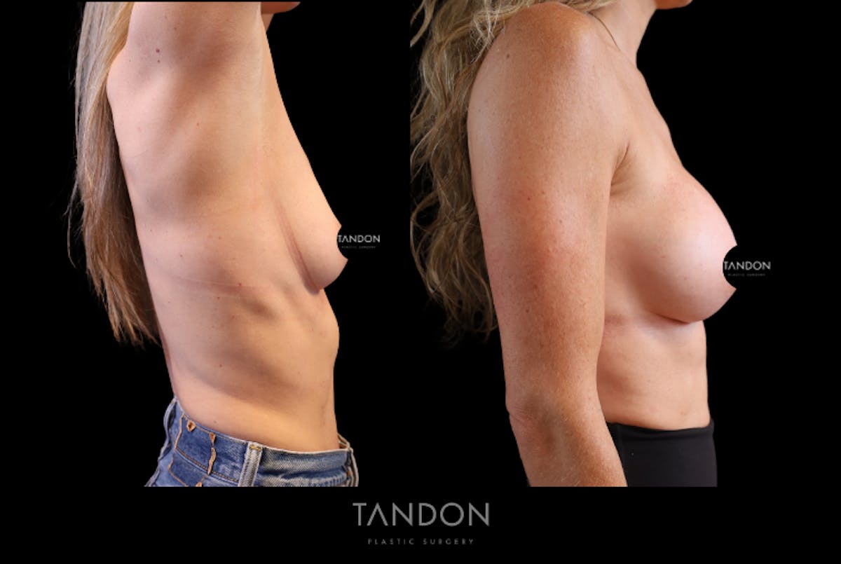 Breast Augmentation  Before & After Gallery - Patient 710988 - Image 5