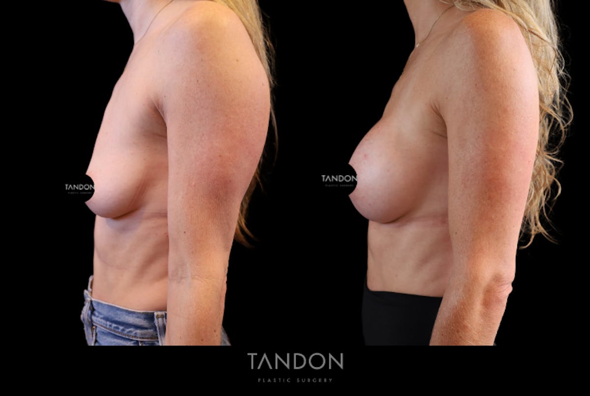 Breast Augmentation  Before & After Gallery - Patient 710988 - Image 3