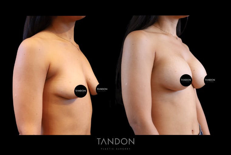 Breast Augmentation Before & After Gallery - Patient 335903 - Image 2