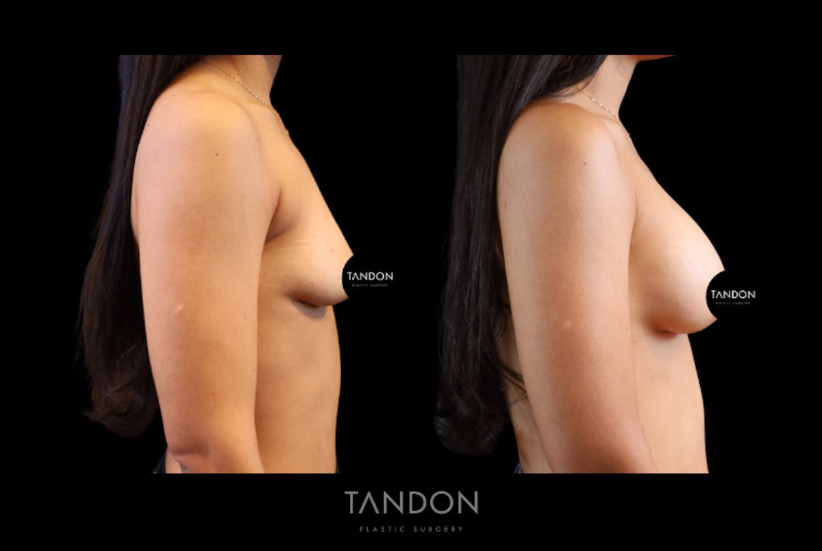 Breast Augmentation Before & After Gallery - Patient 335903 - Image 3
