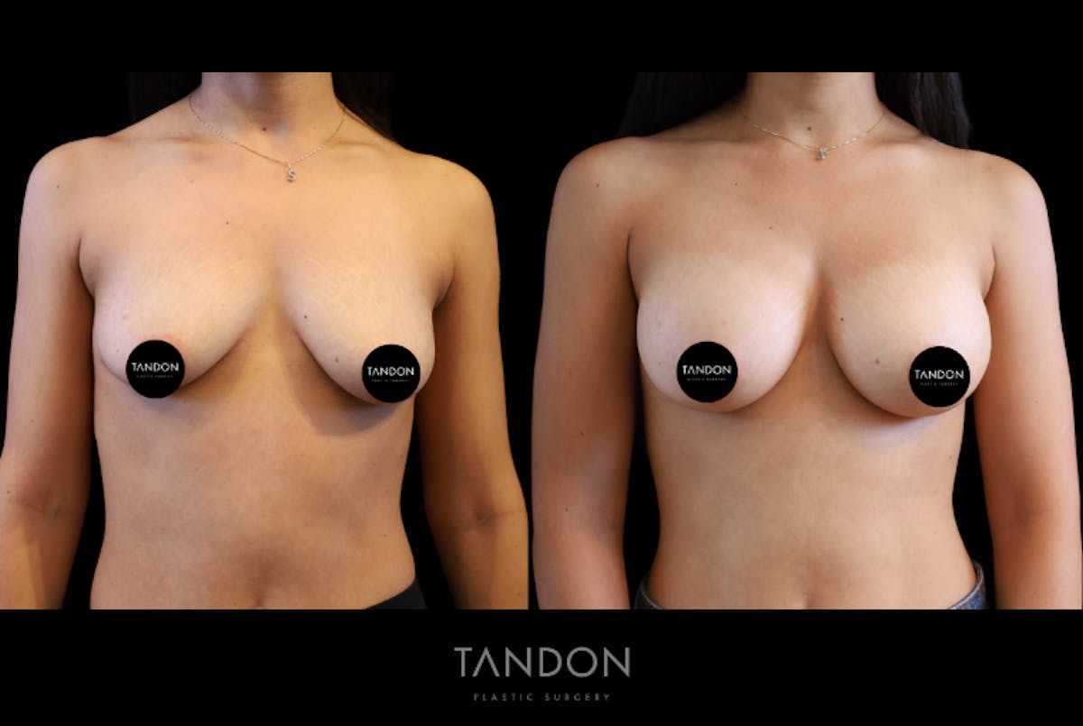 Breast Augmentation Before & After Gallery - Patient 335903 - Image 1