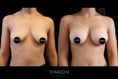 Breast Augmentation Before & After Gallery - Patient 335903 - Image 1