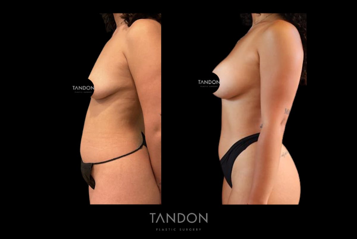 Breast Augmentation Before & After Gallery - Patient 410158 - Image 3