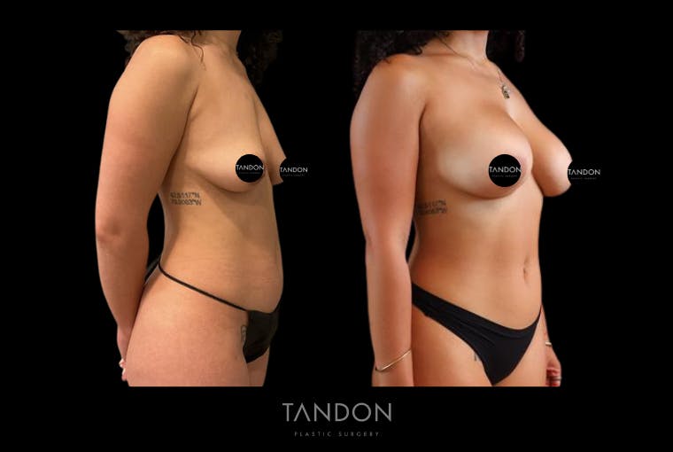 Breast Augmentation Before & After Gallery - Patient 410158 - Image 5