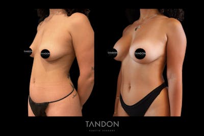 Liposuction and Fat Transfer Before & After Gallery - Patient 377794 - Image 2