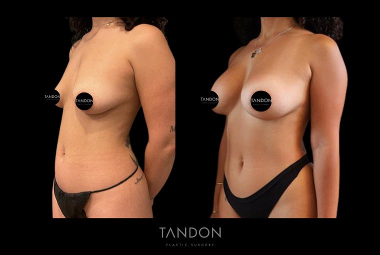 Breast Augmentation Before & After Gallery - Patient 410158 - Image 2