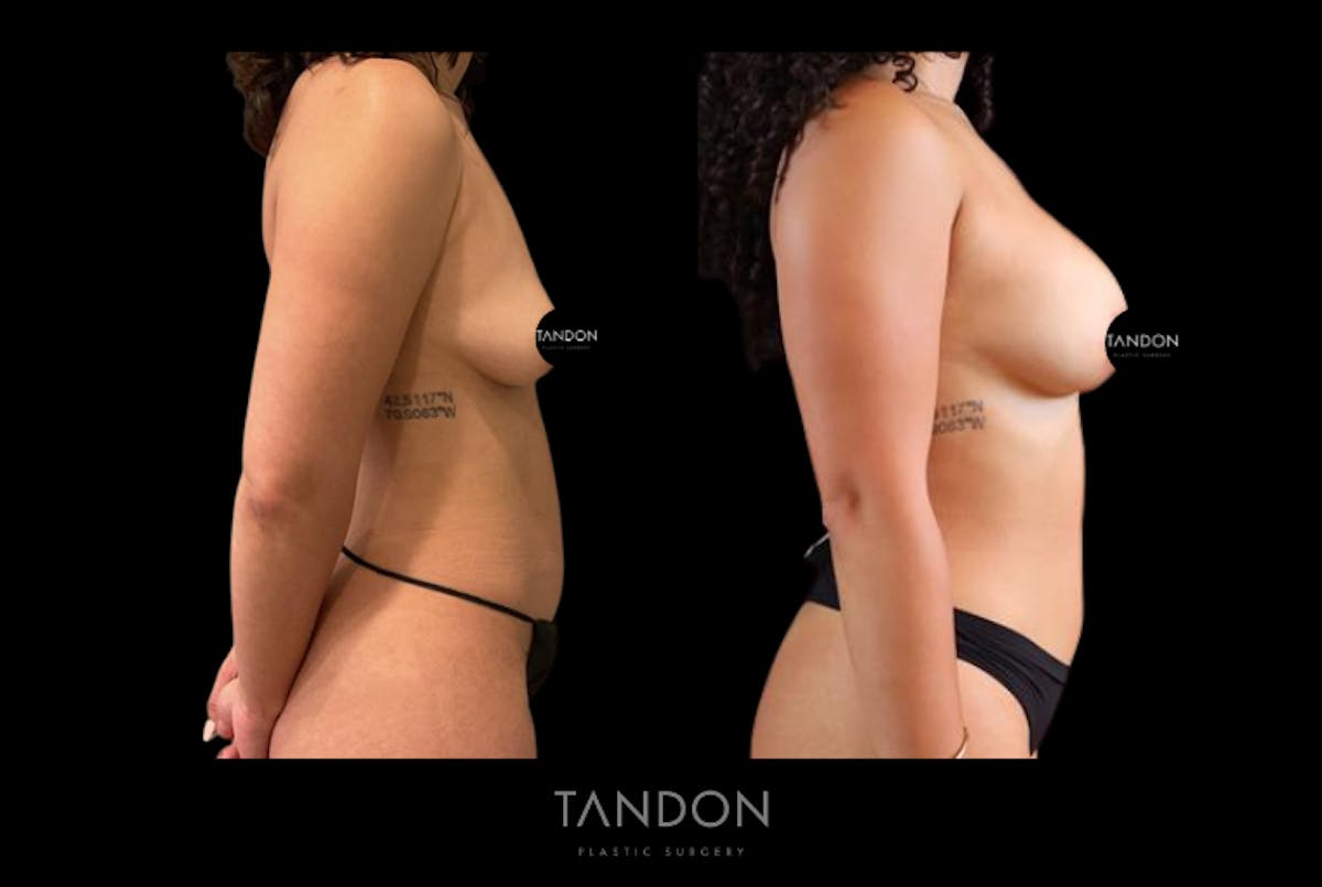 Breast Augmentation Before & After Gallery - Patient 410158 - Image 4