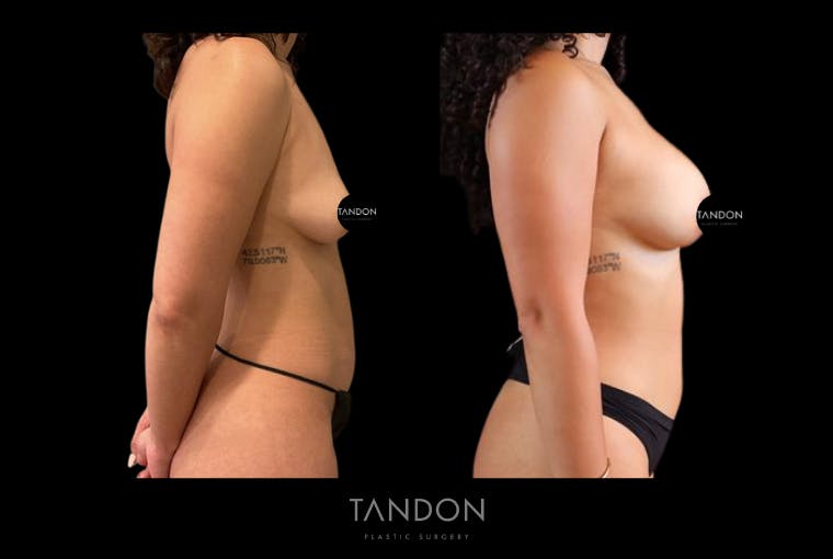 Breast Augmentation Before & After Gallery - Patient 410158 - Image 4