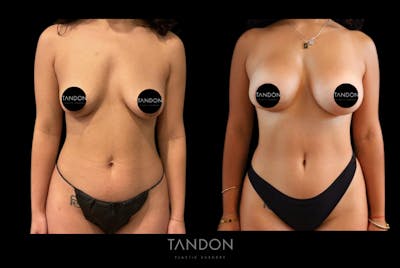 Breast Augmentation Before & After Gallery - Patient 410158 - Image 1