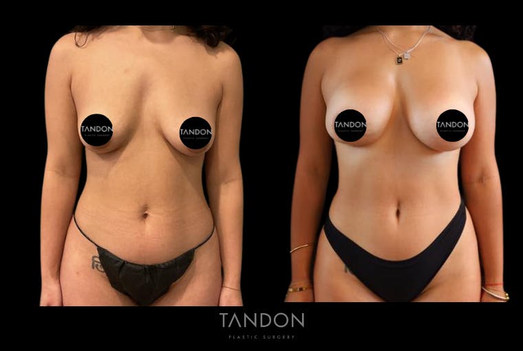 Breast Augmentation Before & After Gallery - Patient 410158 - Image 1