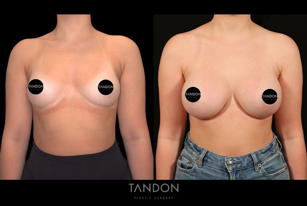Breast Augmentation Before & After Gallery - Patient 258676 - Image 1