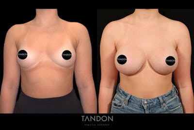 Breast Augmentation Before & After Gallery - Patient 258676 - Image 1