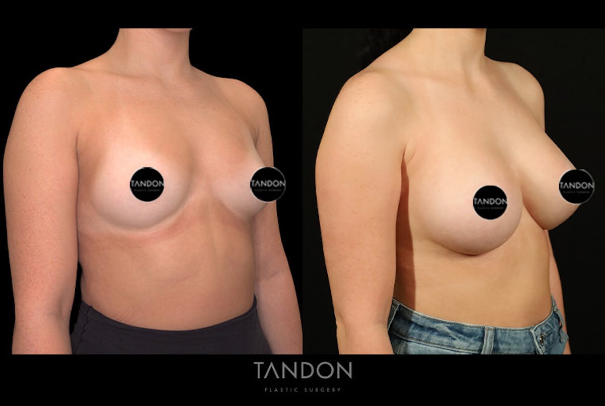 Breast Augmentation Before & After Gallery - Patient 258676 - Image 2