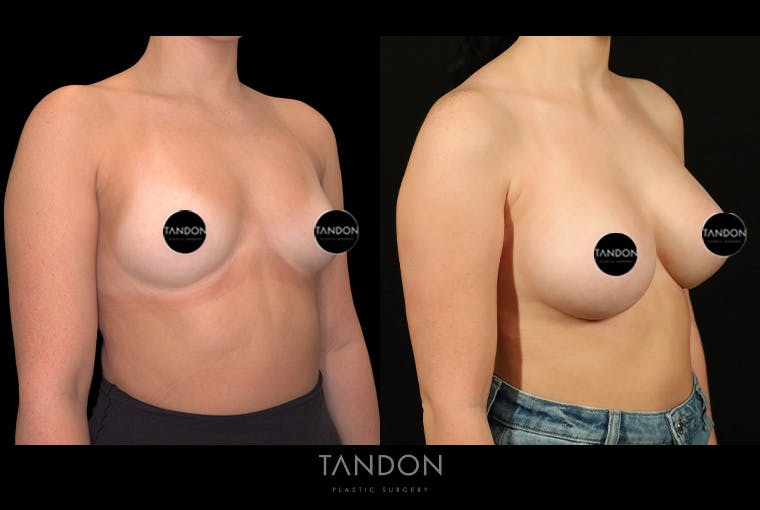 Breast Augmentation Before & After Gallery - Patient 258676 - Image 2