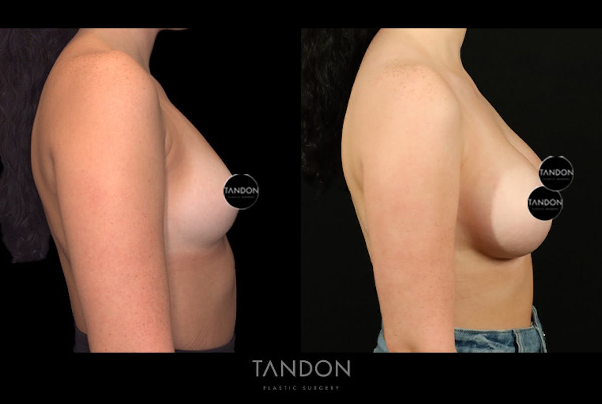 Breast Augmentation Before & After Gallery - Patient 258676 - Image 3