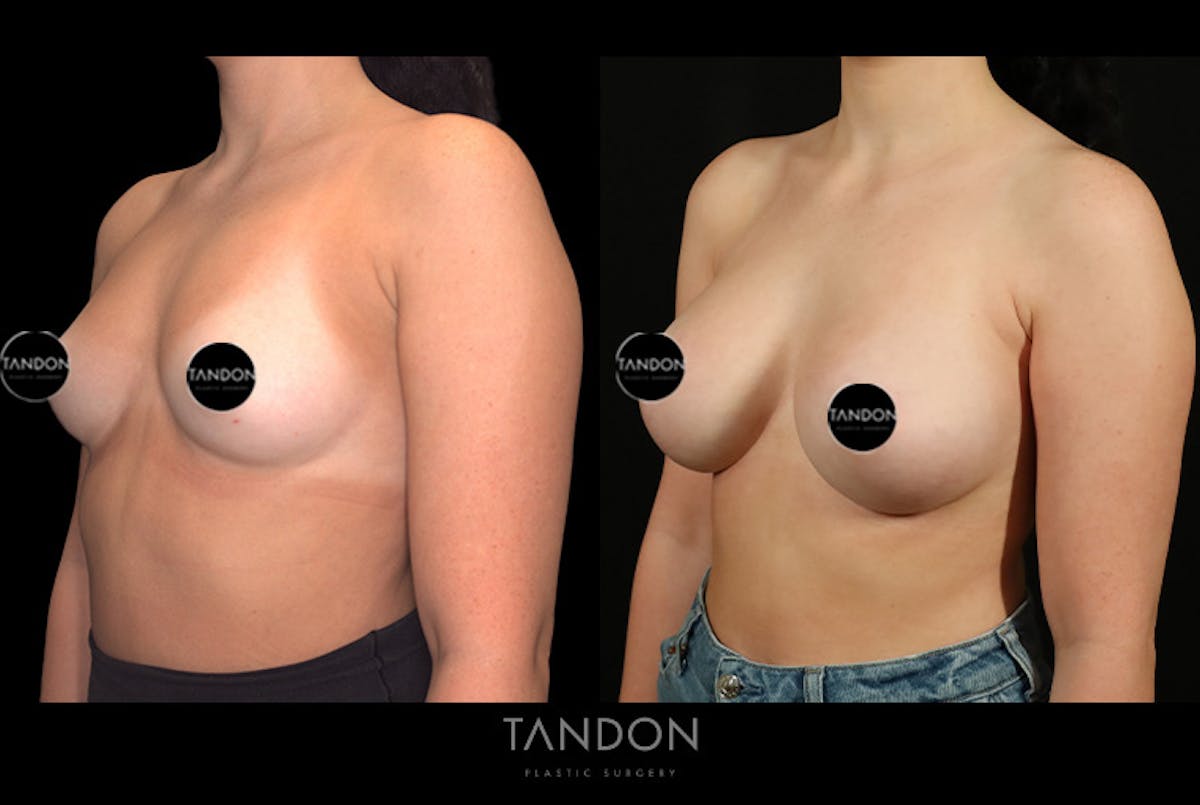 Breast Augmentation Before & After Gallery - Patient 258676 - Image 4