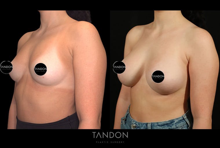 Breast Augmentation Before & After Gallery - Patient 258676 - Image 4