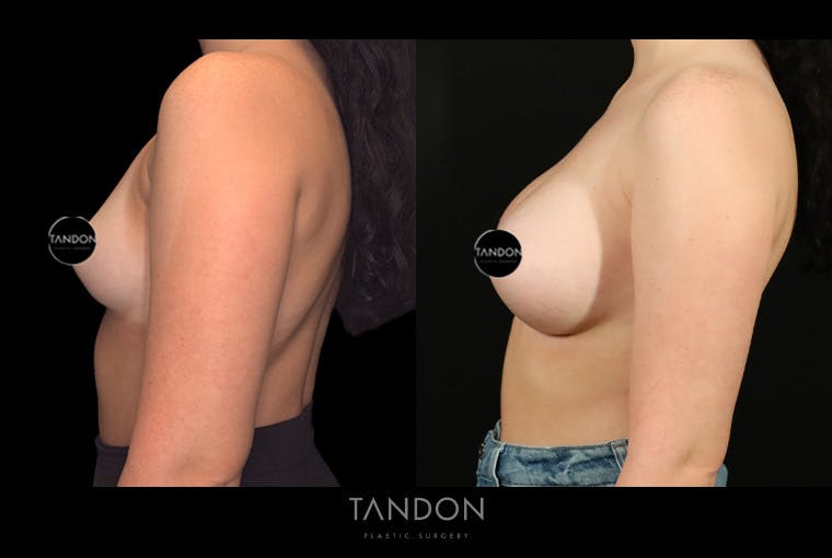 Breast Augmentation Before & After Gallery - Patient 258676 - Image 5