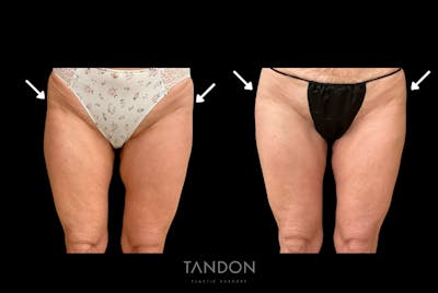 AlloClae Before & After Gallery - Patient 408676 - Image 1