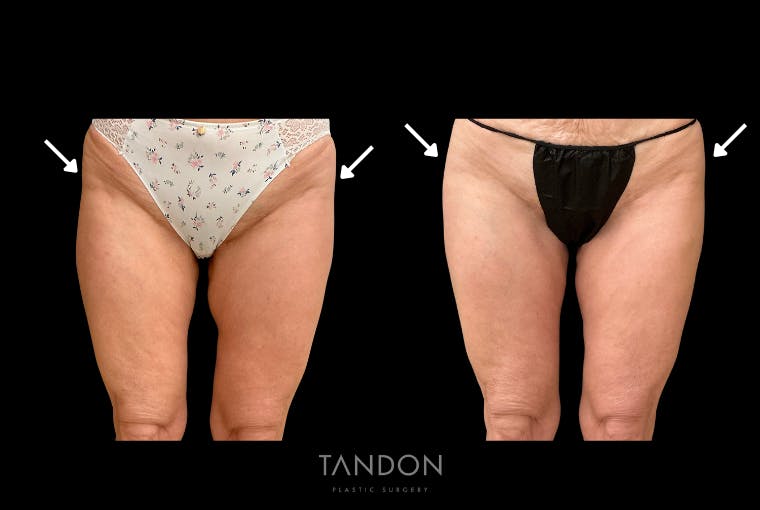 AlloClae Before & After Gallery - Patient 408676 - Image 1