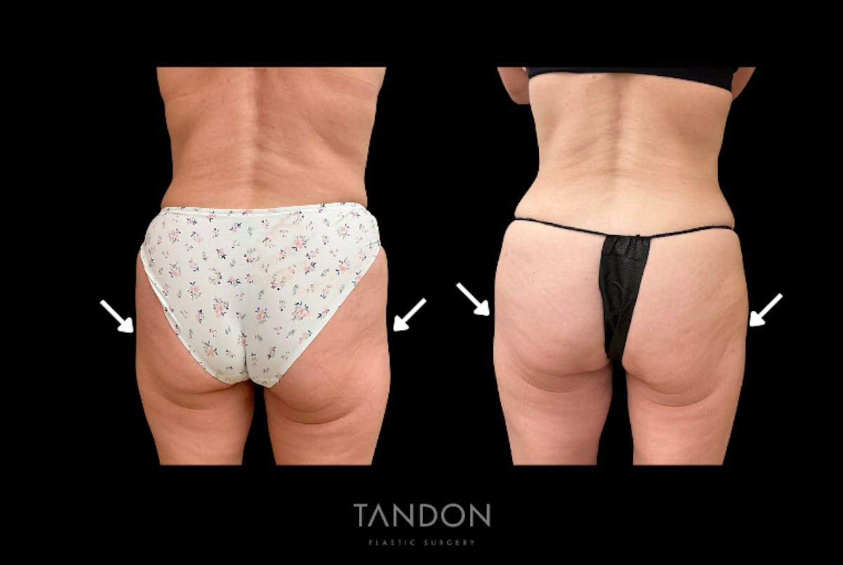 AlloClae Before & After Gallery - Patient 408676 - Image 2