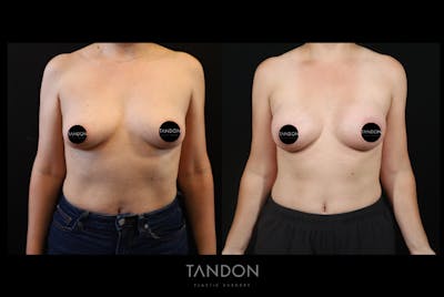 Breast Augmentation Before & After Gallery - Patient 155622 - Image 1