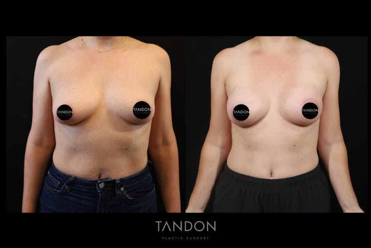 Breast Augmentation Before & After Gallery - Patient 155622 - Image 1