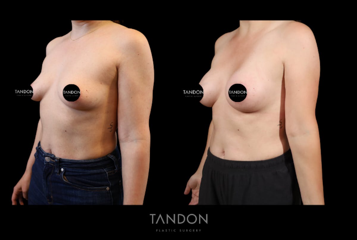Breast Augmentation Before & After Gallery - Patient 155622 - Image 5