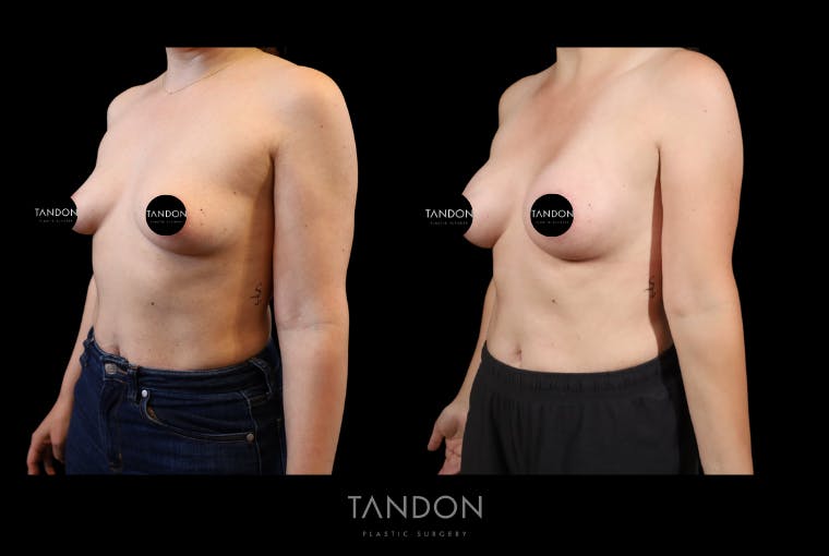 Breast Augmentation Before & After Gallery - Patient 155622 - Image 5