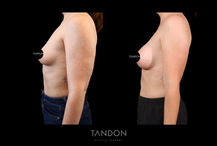 Breast Augmentation Before & After Gallery - Patient 155622 - Image 4