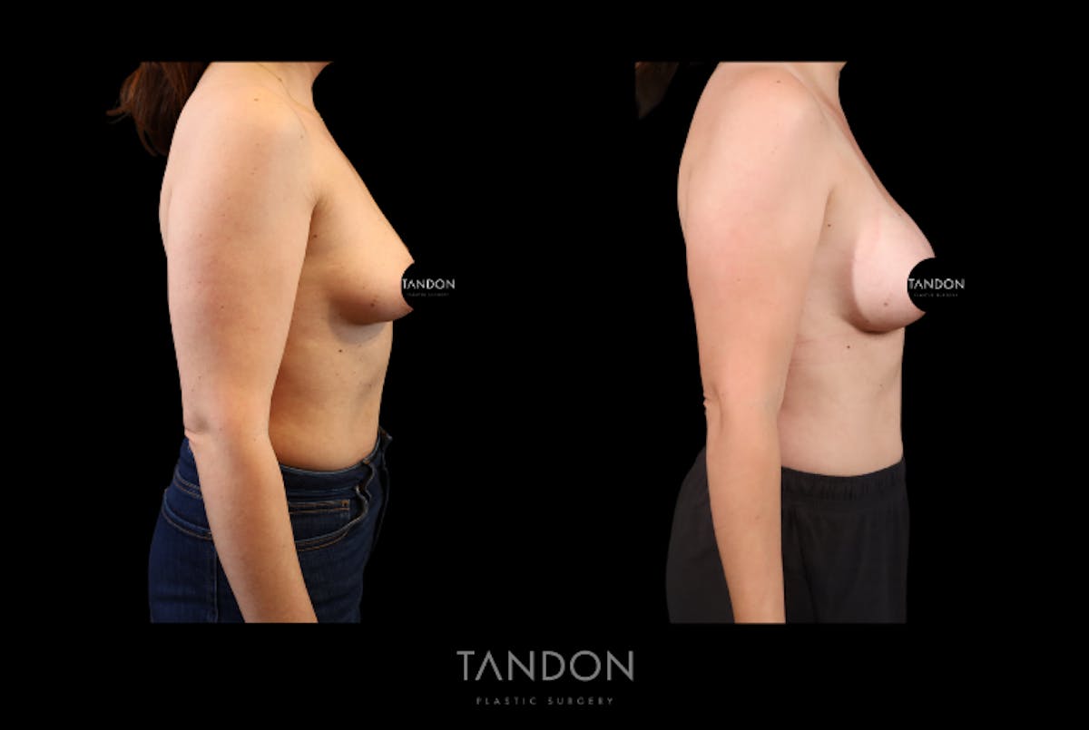 Breast Augmentation Before & After Gallery - Patient 155622 - Image 2