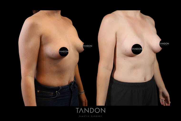 Breast Augmentation Before & After Gallery - Patient 155622 - Image 3