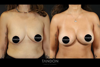 Breast Augmentation Before & After Gallery - Patient 401875 - Image 1