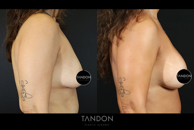 Breast Augmentation Before & After Gallery - Patient 401875 - Image 3