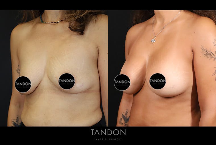 Breast Augmentation Before & After Gallery - Patient 401875 - Image 4