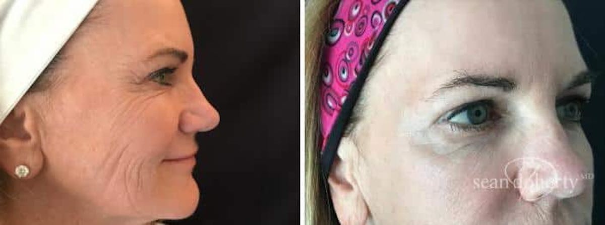 Botox Before & After Gallery - Patient 262325 - Image 1