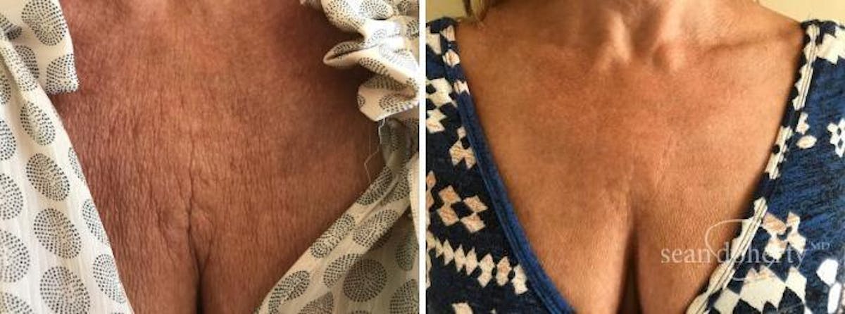 Botox Before & After Gallery - Patient 349850 - Image 1