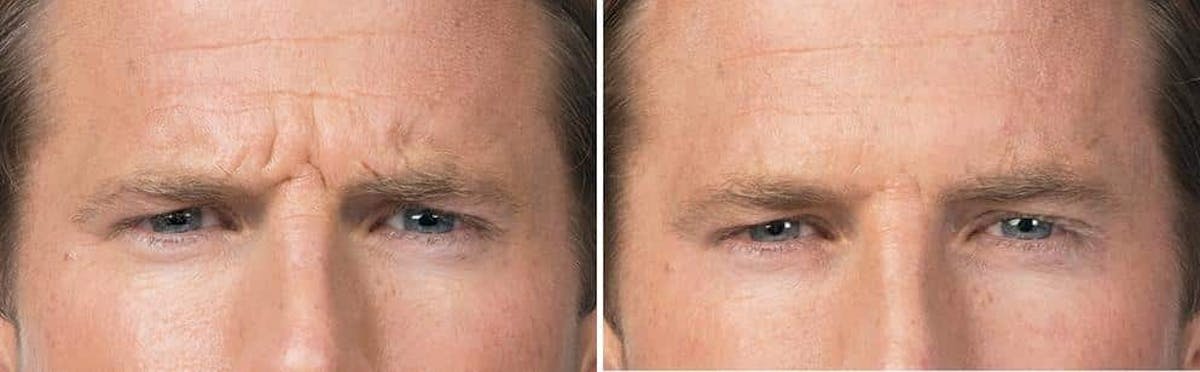 Botox Before & After Gallery - Patient 655170 - Image 1