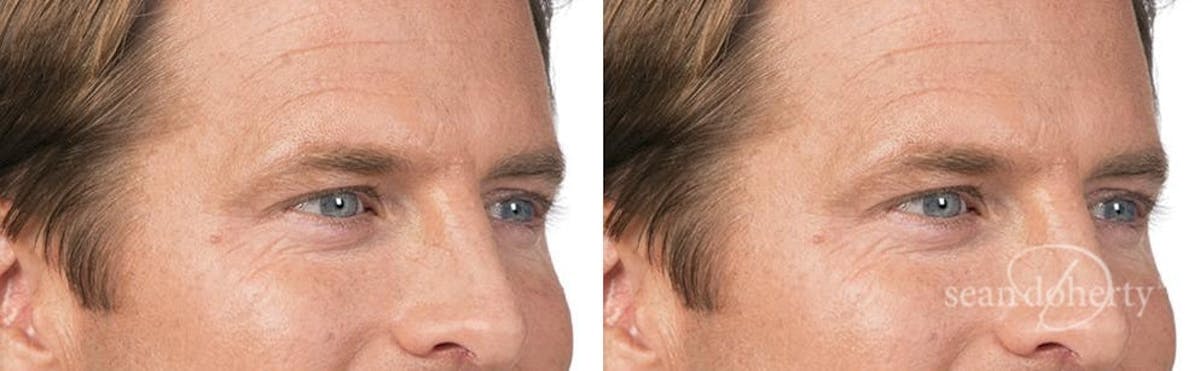 Botox Before & After Gallery - Patient 655170 - Image 2
