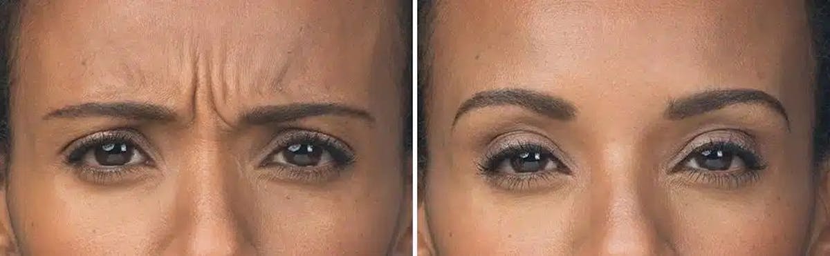 Botox Before & After Gallery - Patient 391921 - Image 1