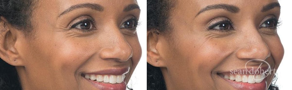 Botox Before & After Gallery - Patient 391921 - Image 2