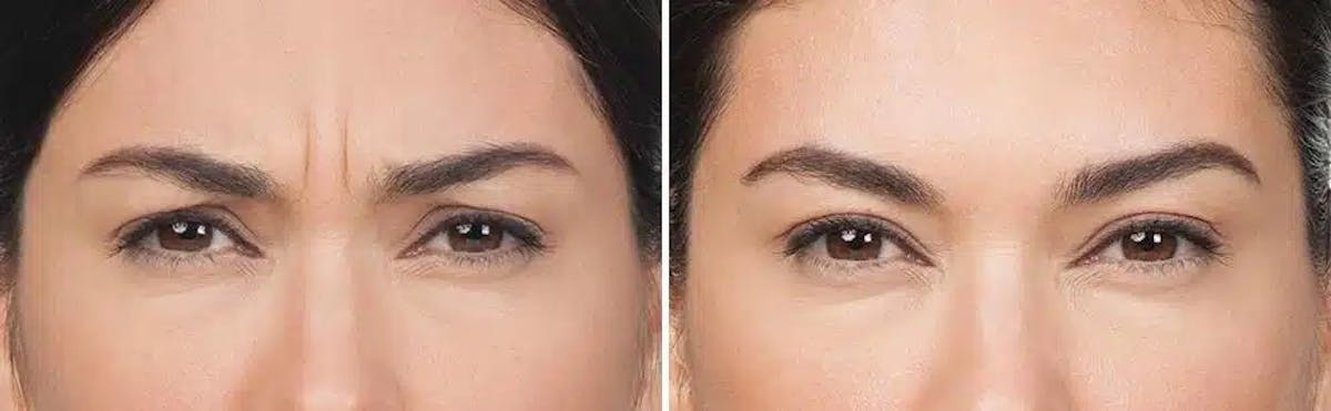 Botox Before & After Gallery - Patient 676530 - Image 1
